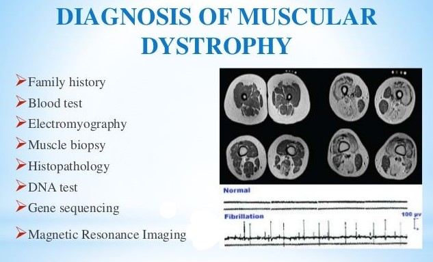 Diagnosis – MIND Trust – Mobility in Dystrophy